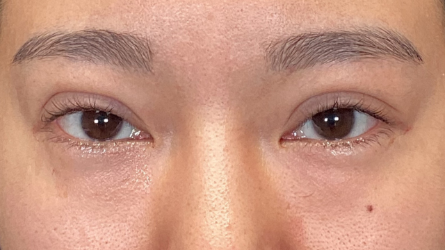 手術前の状態 その1