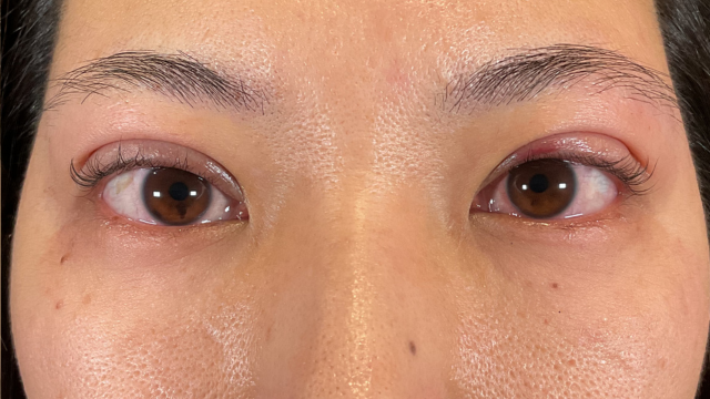 手術前の状態 その1