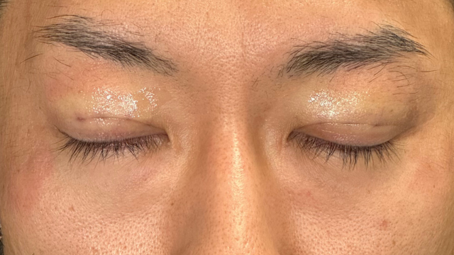 手术前的状态 其一