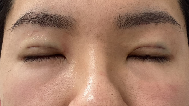 手術前の状態 その1