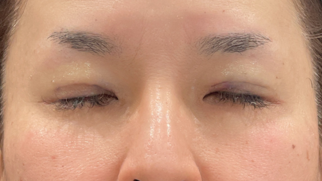 手术前的状态 其一