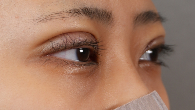 手術前の状態 その1