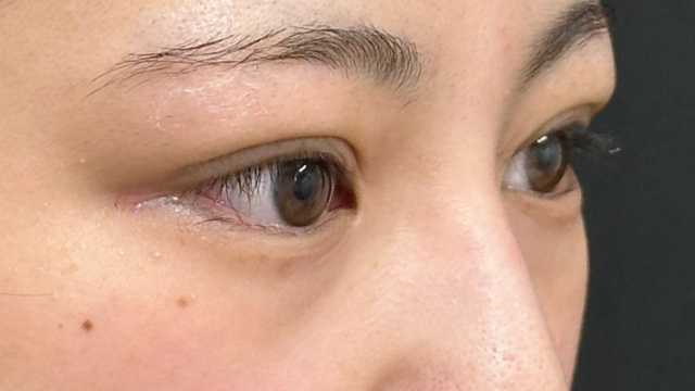 手術前の状態 その1