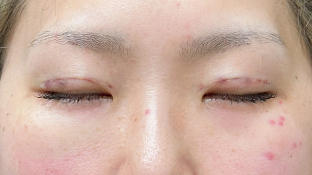 手术前的状态 其一