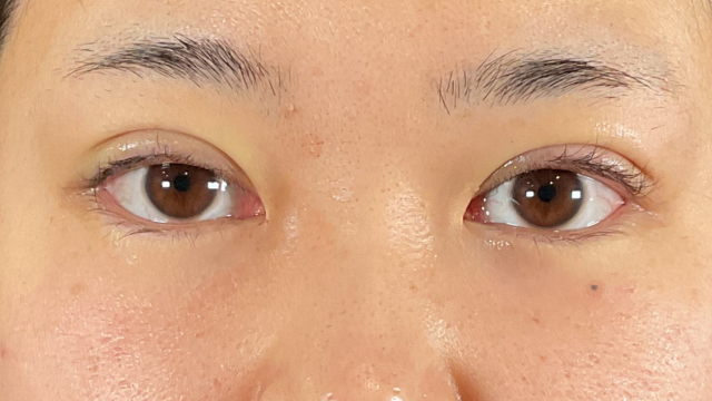 手术前的状态 其一