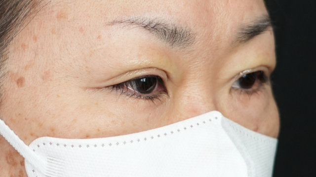 手術前の状態 その1