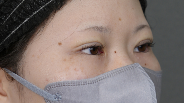 手术前的状态 其一