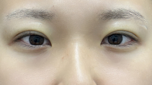 手术前的状态 其一