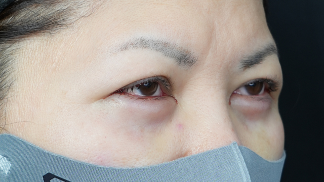 手術前の状態 その1