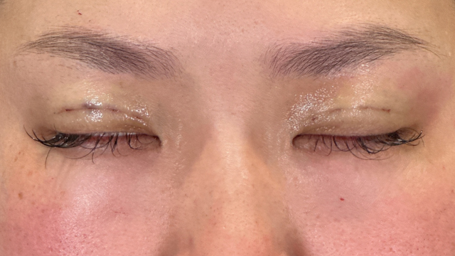 手术前的状态 其一