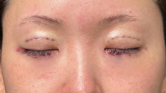 Postoperative Condition Part 1