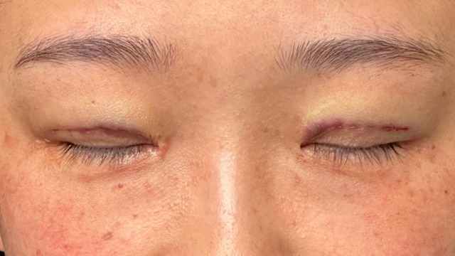 手术前的状态 其一