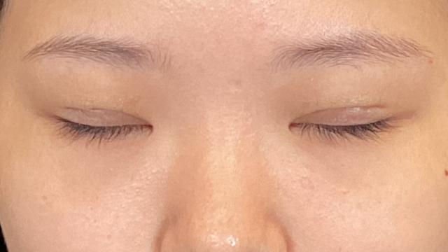 Postoperative Condition Part 1