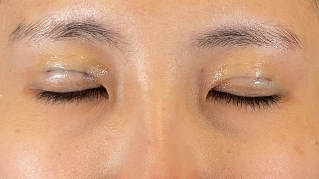 手術前の状態 その1