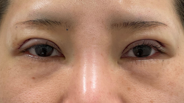 手術前の状態 その1