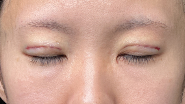 手术前的状态 其一