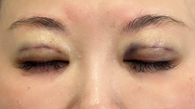 手术前的状态 其一