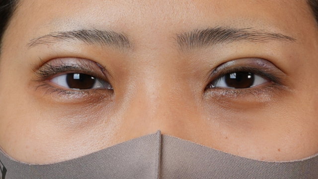 手術前の状態 その1