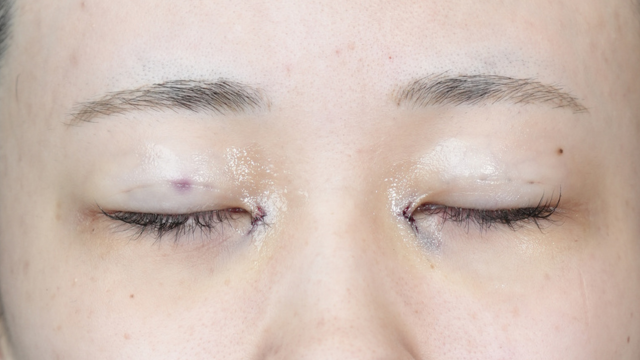 手術前の状態 その1