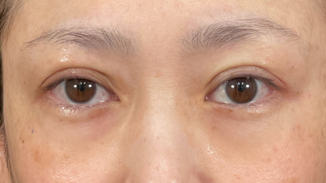 手術前の状態 その1