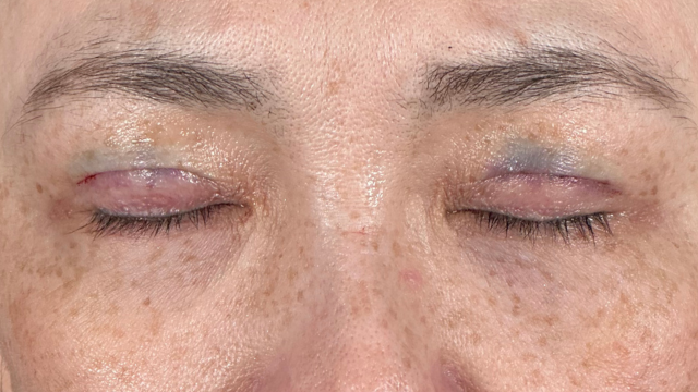 手术前的状态 其一