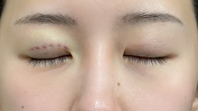 手术前的状态 其一