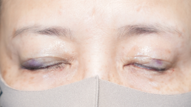 手術前の状態 その1