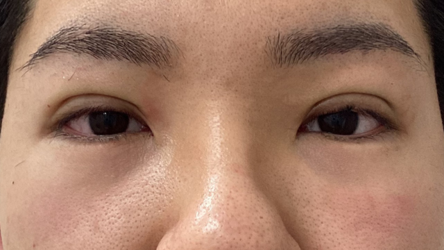 手術前の状態 その1