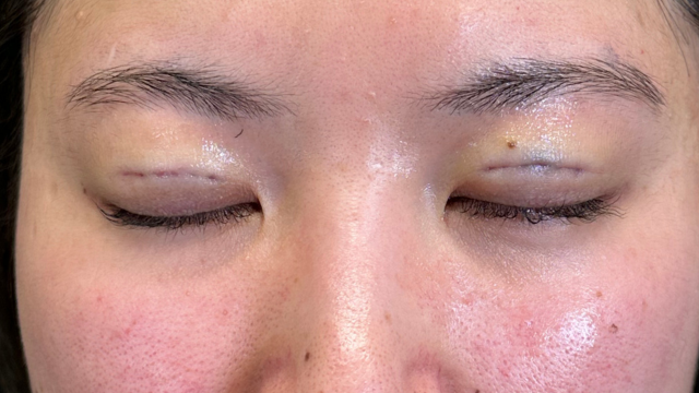 手術前の状態 その1