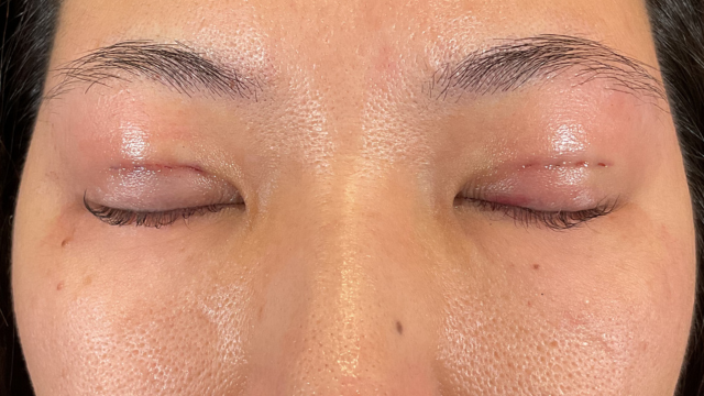 手術前の状態 その1