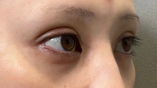 手术前的状态 其一