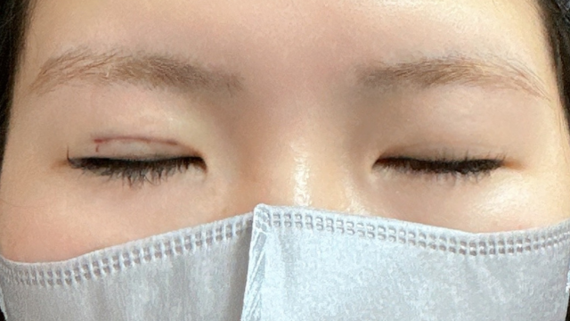 手术前的状态 其一