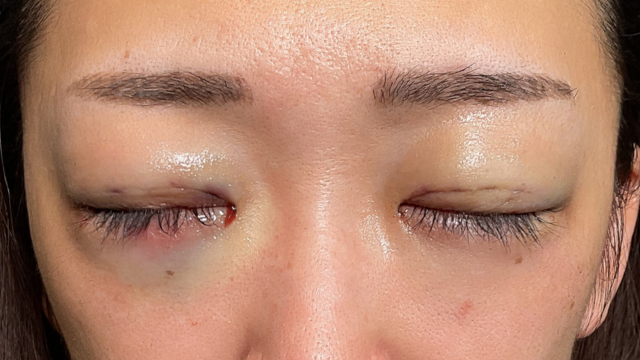 手術前の状態 その1