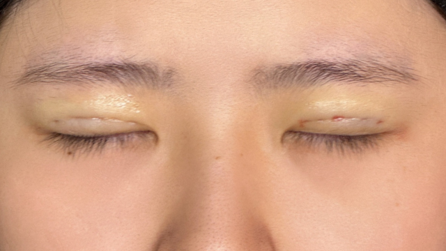 手术前的状态 其一