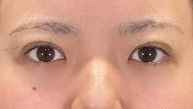 手術前の状態 その1