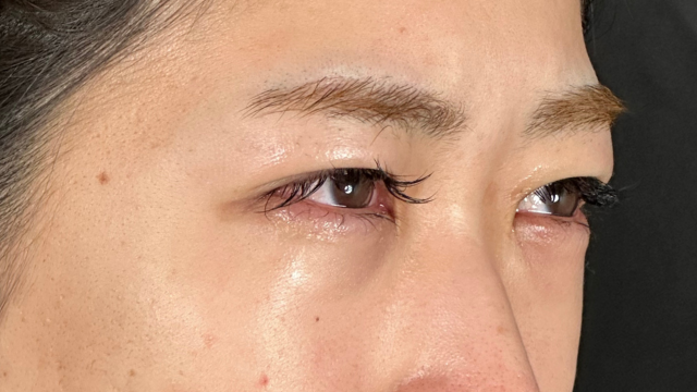 手术前的状态 其一