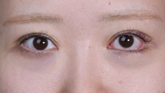 手术前的状态 其一