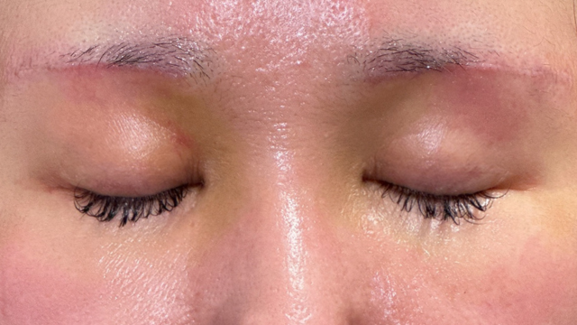 Postoperative Condition Part 1