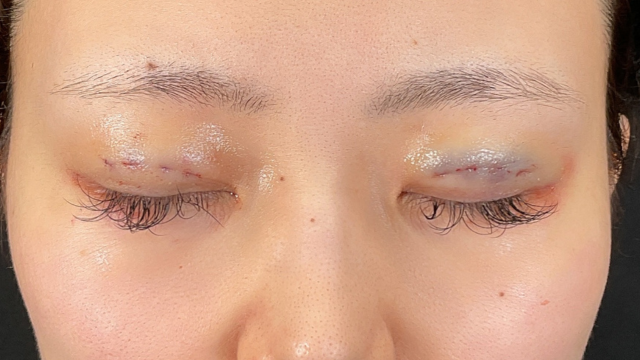 手术前的状态 其一