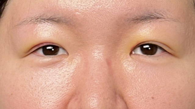 手术前的状态 其一