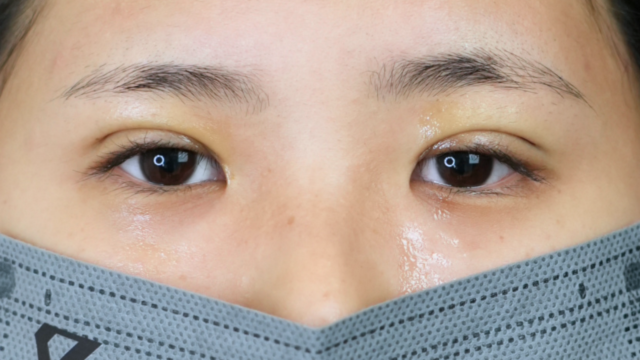 手术前的状态 其一