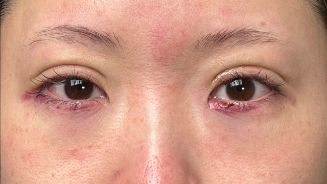 手术前的状态 其一