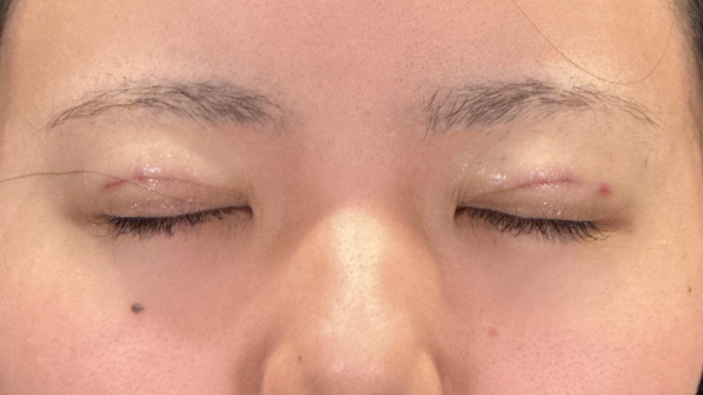 手術前の状態 その1