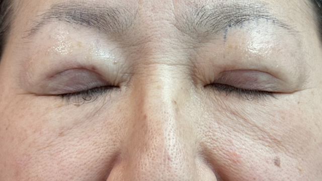 手术前的状态 其一