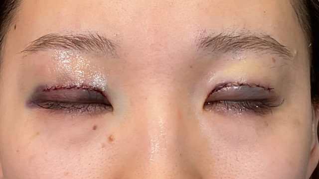 手術前の状態 その1