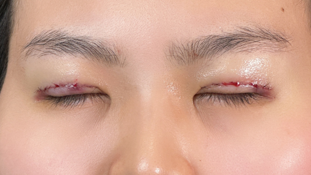 手术前的状态 其一