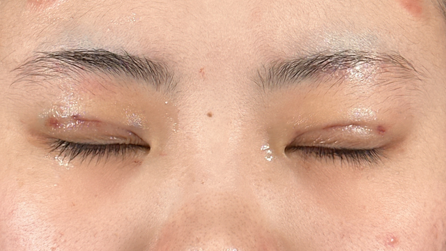 Postoperative Condition Part 1