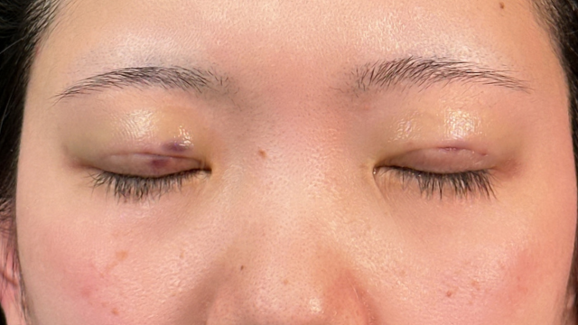 手术前的状态 其一