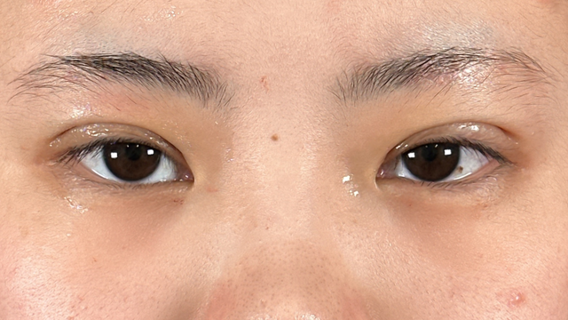 Postoperative Condition Part 1