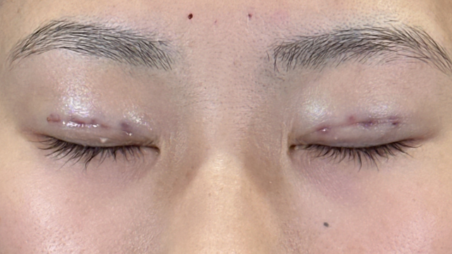 手術前の状態 その1